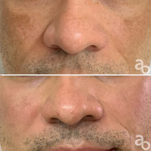 Tratamento de Melasma