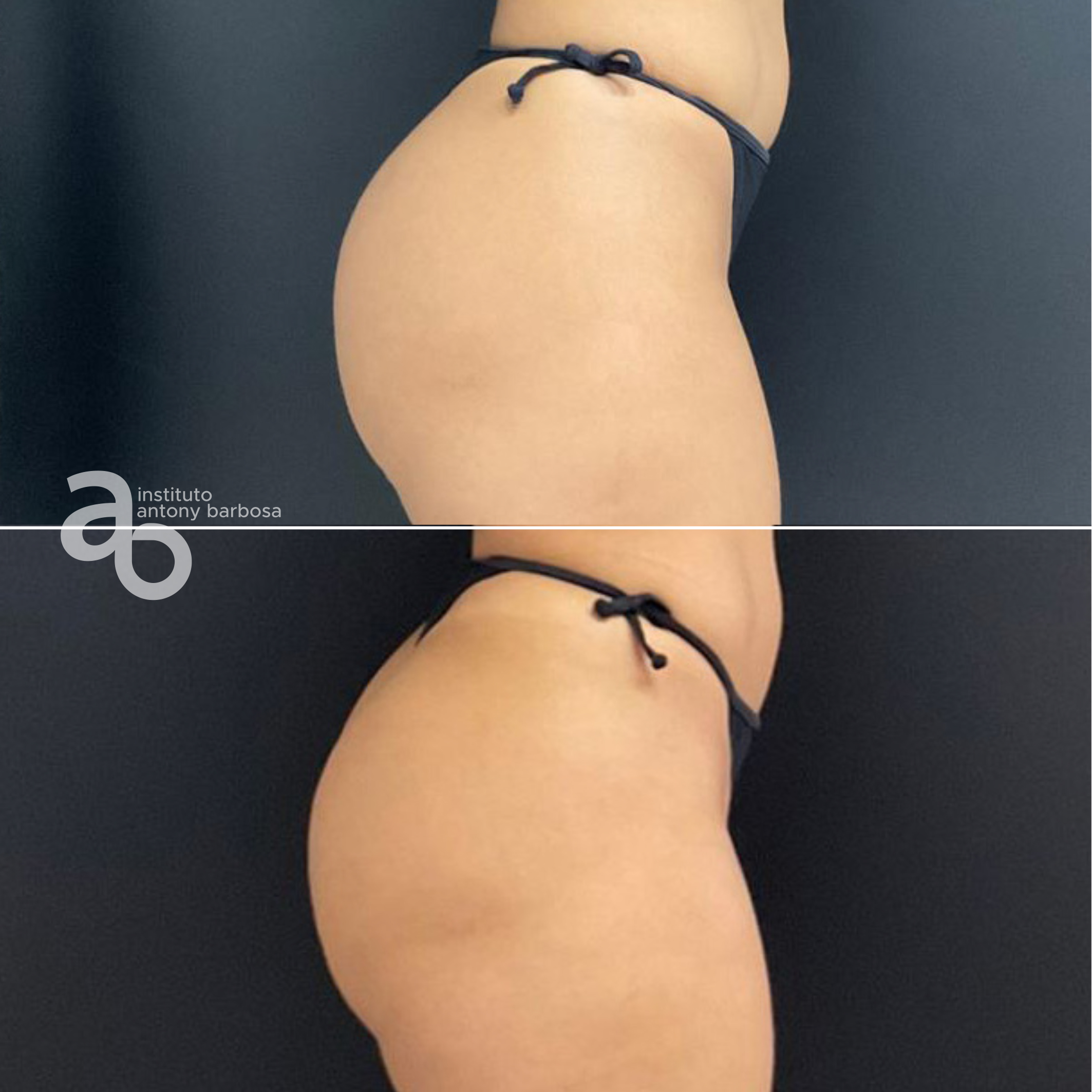 Foto Glúteo Grasi-2