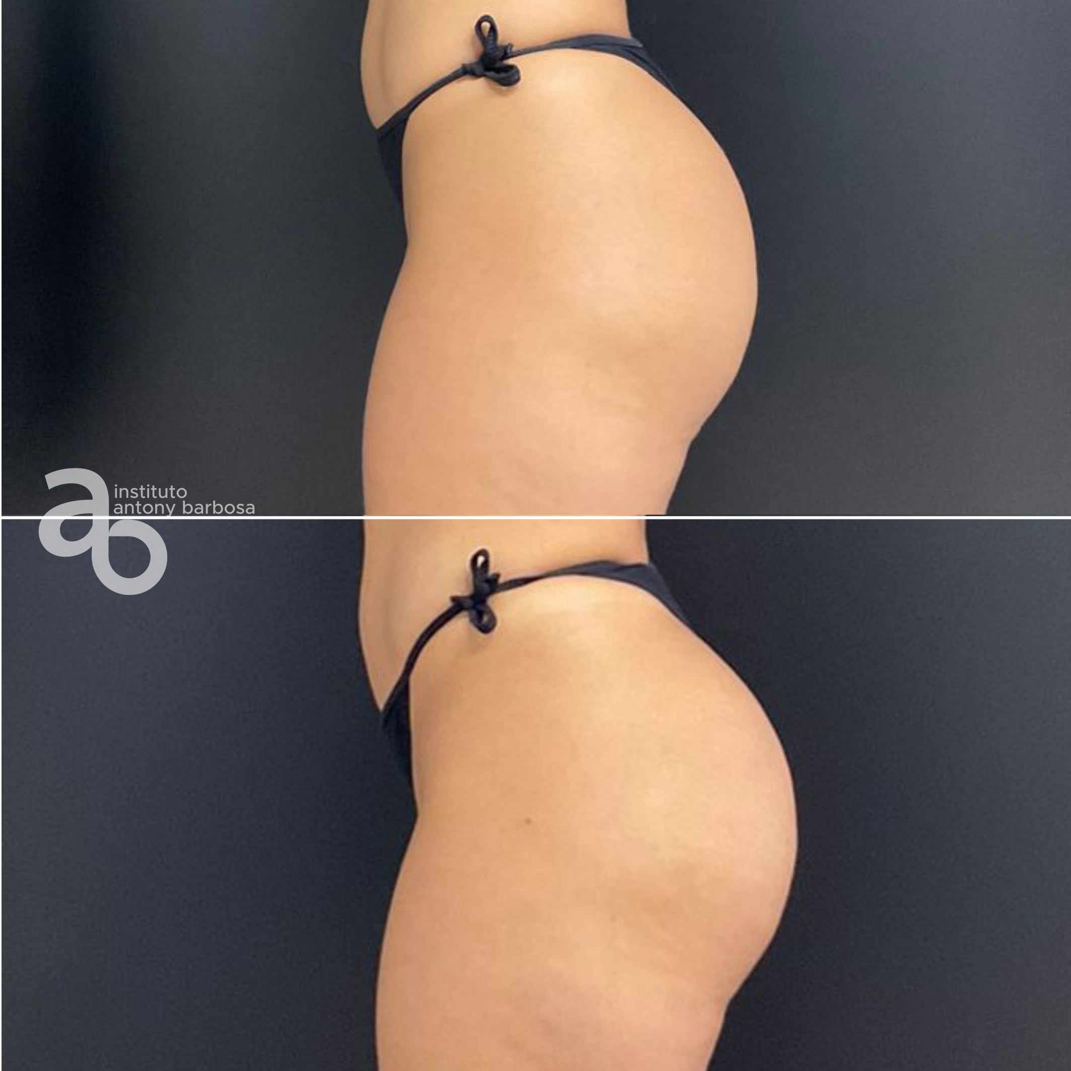 Foto Glúteo Grasi-3