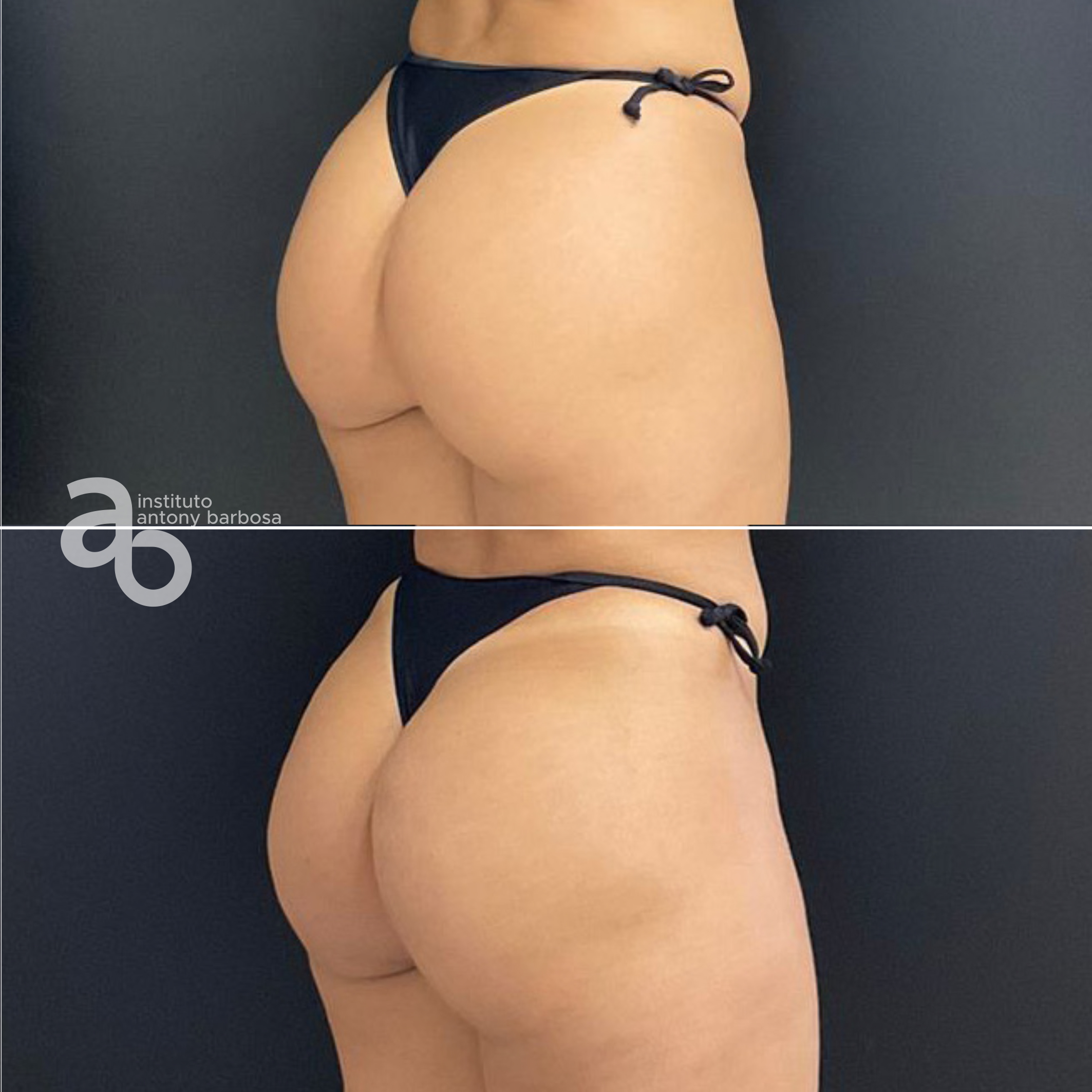 Foto Glúteo Grasi-4