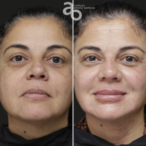 Perfiloplastia 1 quadrado _ Gisele-1