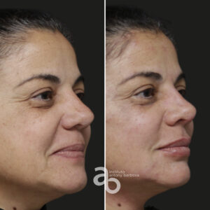 Perfiloplastia 1 quadrado _ Gisele-2