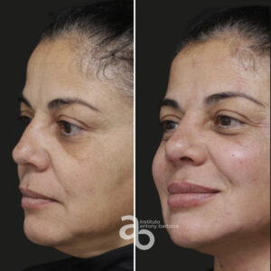 Perfiloplastia 1 quadrado _ Gisele-3