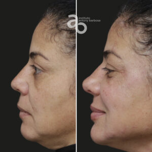 Perfiloplastia 1 quadrado _ Gisele-4