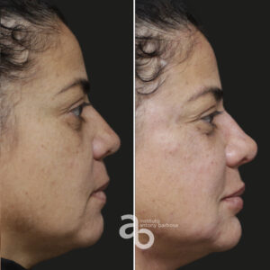 Perfiloplastia 1 quadrado _ Gisele-5