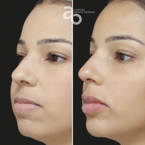 Perfiloplastia 2 quadrado _ Poliana-2