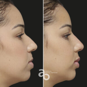 Perfiloplastia 2 quadrado _ Poliana-5