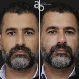 Perfiloplastia 3 quadrado _ Caio-1