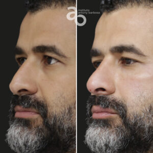 Perfiloplastia 3 quadrado _ Caio-2