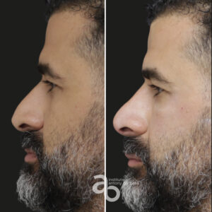 Perfiloplastia 3 quadrado _ Caio-3