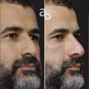 Perfiloplastia 3 quadrado _ Caio-4