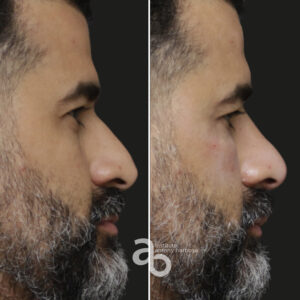 Perfiloplastia 3 quadrado _ Caio-5