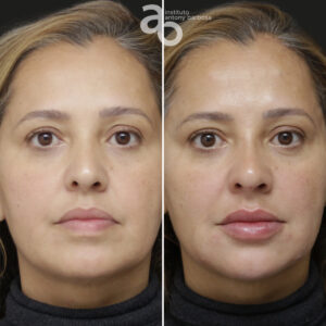 Perfiloplastia 4 quadrado _ Michele-1