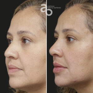 Perfiloplastia 4 quadrado _ Michele-2