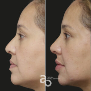 Perfiloplastia 4 quadrado _ Michele-3