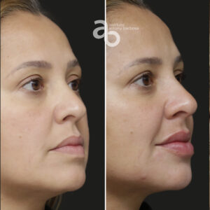 Perfiloplastia 4 quadrado _ Michele-4