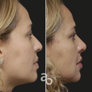 Perfiloplastia 4 quadrado _ Michele-5