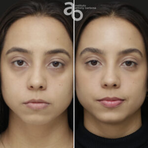 Perfiloplastia 6 quadrado _ Bárbara-1