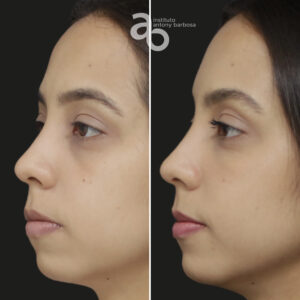 Perfiloplastia 6 quadrado _ Bárbara-2