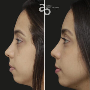 Perfiloplastia 6 quadrado _ Bárbara-3
