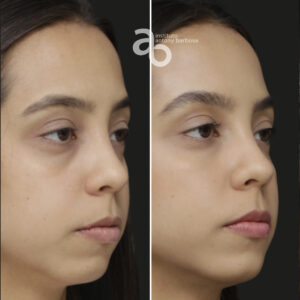 Perfiloplastia 6 quadrado _ Bárbara-4