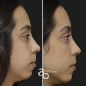 Perfiloplastia 6 quadrado _ Bárbara-5